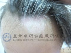 沈某/男性/局限性/头部白斑